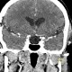 Empty sella, hypophysis: CT - Computed tomography